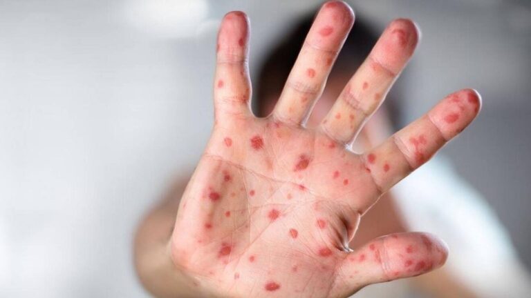 monkeypox