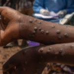 10 KASO NG MPOX NAITALA SA SOUTH COTABATO